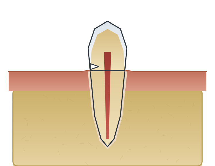 Illustration: Abfraction lesions