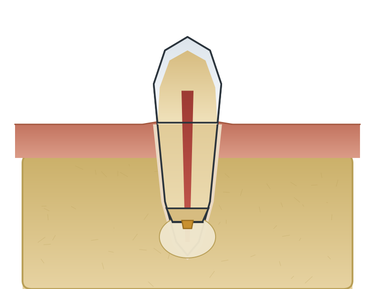 Illustration: Apicoectomy (surgical endodontics)