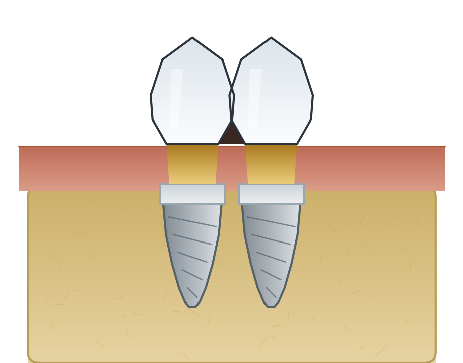 Illustration: Black triangles around implants