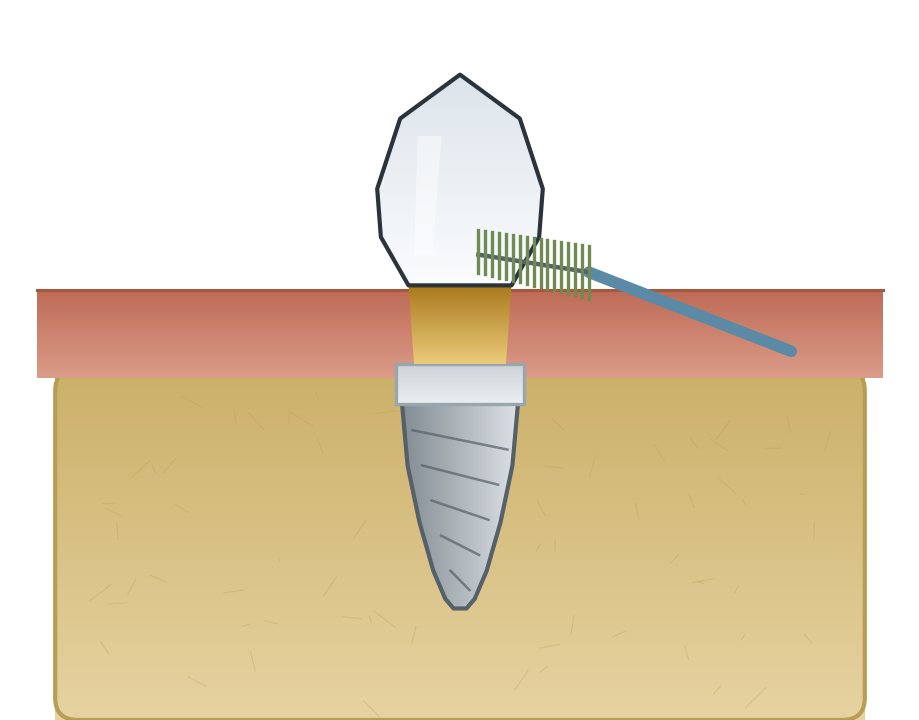 Illustration: Caring for your implants