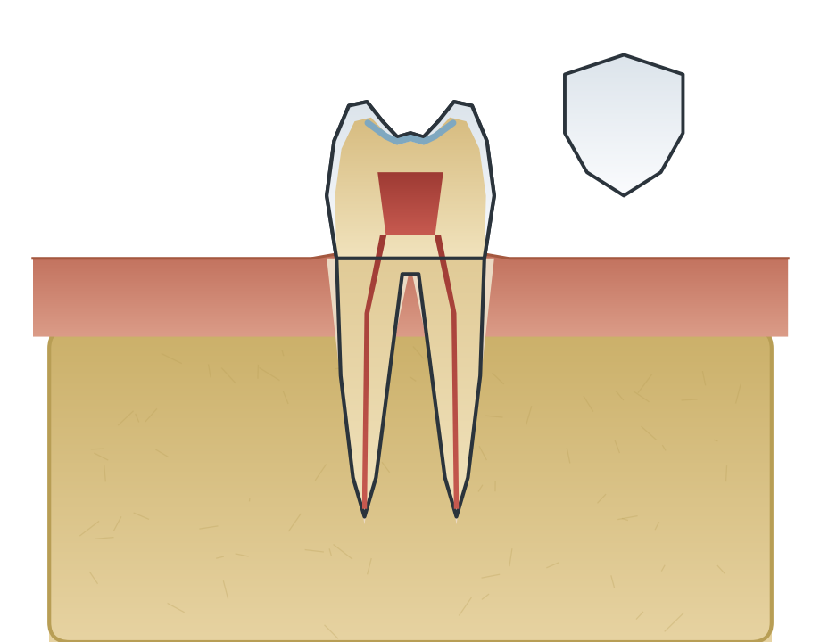 Illustration: Fissure sealants for children