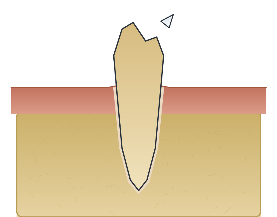 Illustration: Chipped or broken tooth