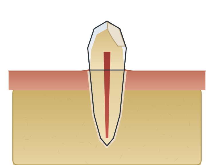 Illustration: Tooth-coloured (composite) filling