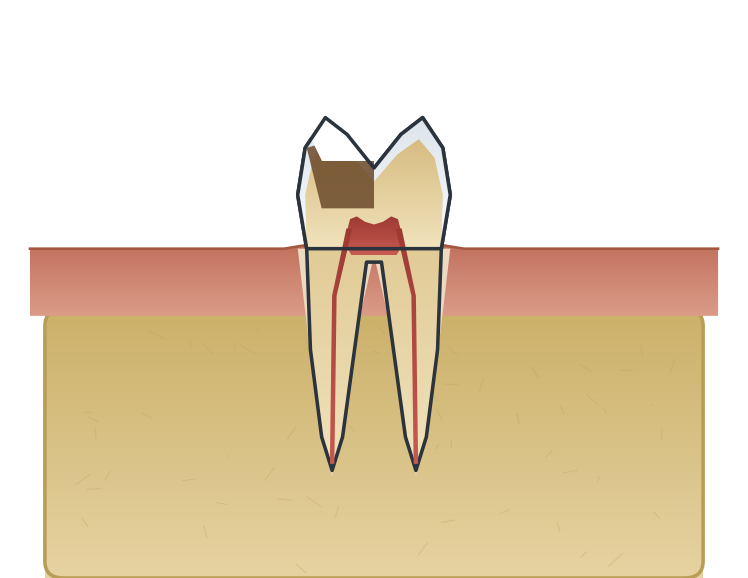 Illustration: Structurally compromised tooth
