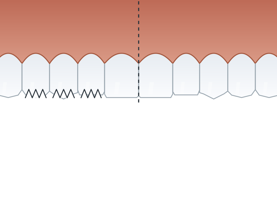 Illustration: Composite (cosmetic) bonding