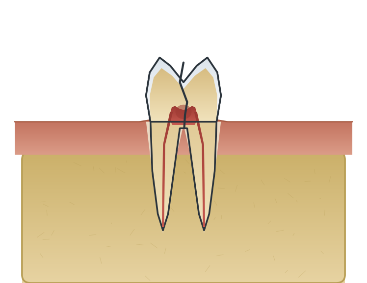 Illustration: Cracked tooth & the nerve
