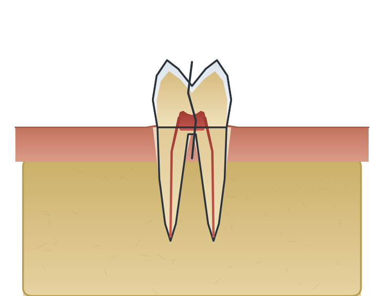 Illustration: Cracked tooth