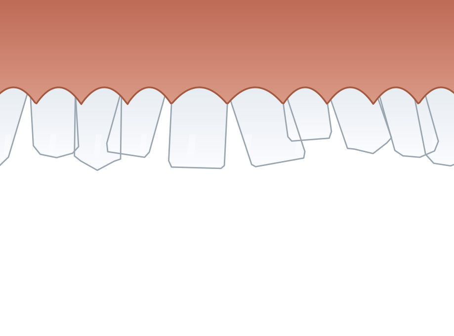 Illustration: Crowded & crooked teeth