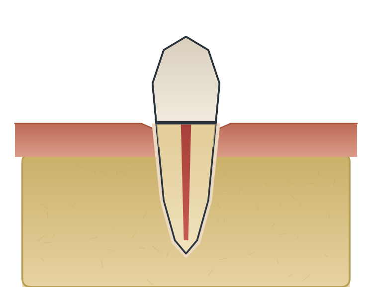 Illustration: Crown lengthening
