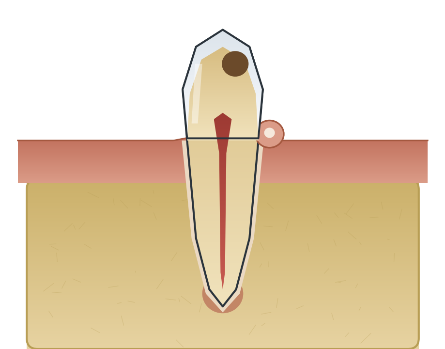 Illustration: Dental abscess & facial swelling
