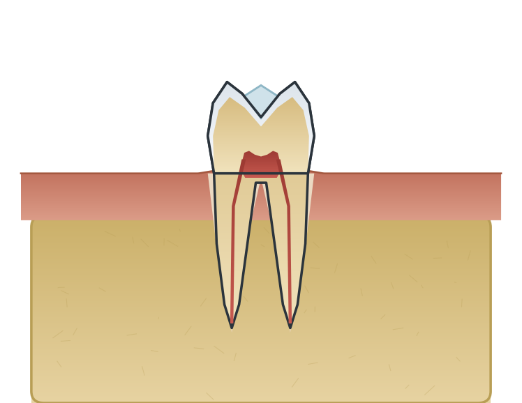 Illustration: Dental sealants