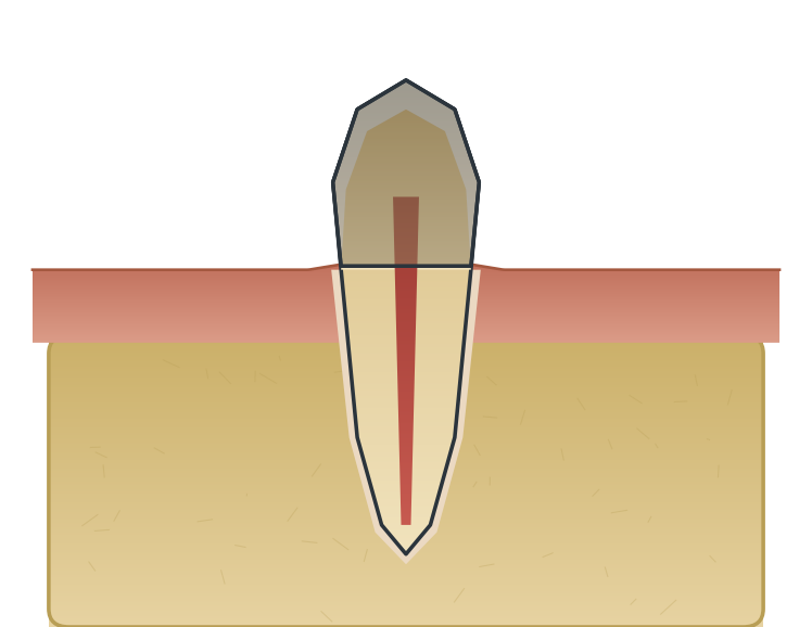 Illustration: Discoloured tooth