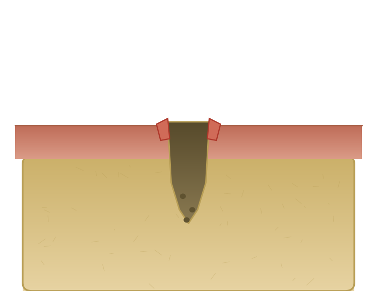 Illustration: Dry socket