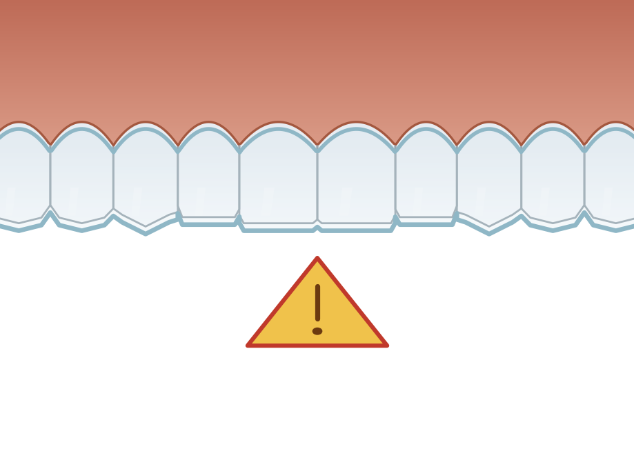 Illustration: Risks of direct-to-consumer aligners