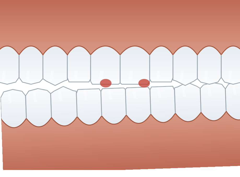 Illustration: Equilibration (bite adjustment)