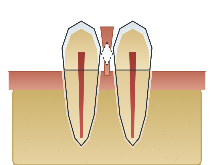 Illustration: Frenectomy & tongue-tie release