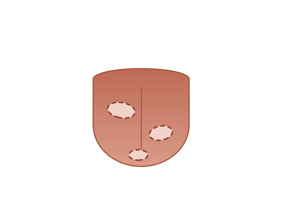 Illustration: Geographic tongue