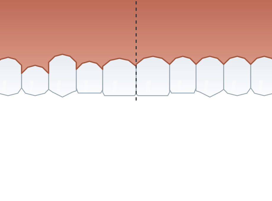 Illustration: Gum aesthetics