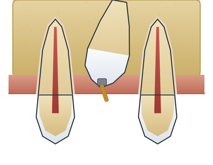 Illustration: Exposure of an impacted canine