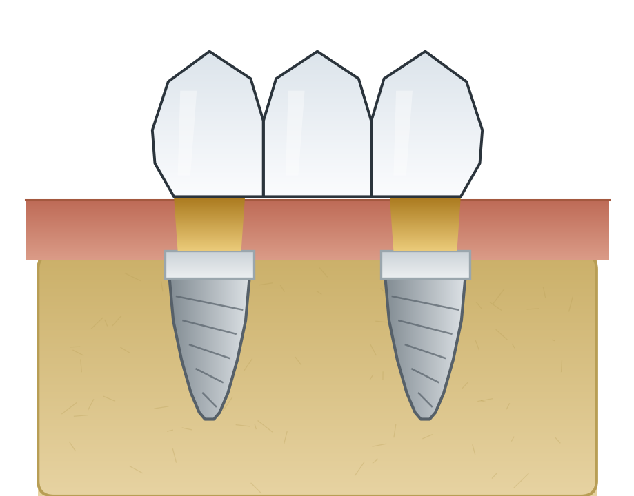 Illustration: Implant-supported bridge