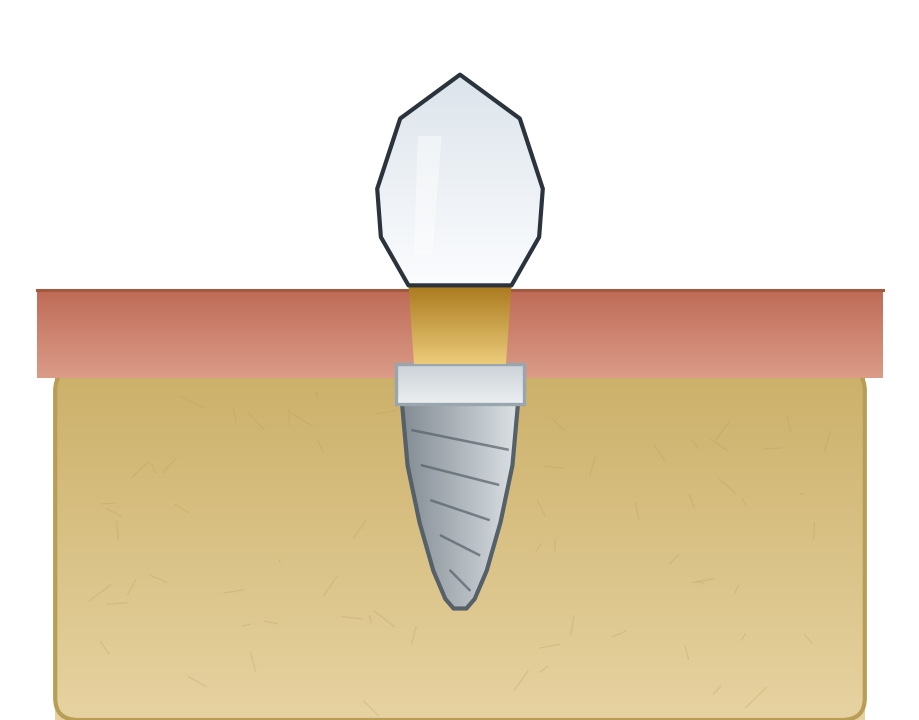 Illustration: Implant-supported crown