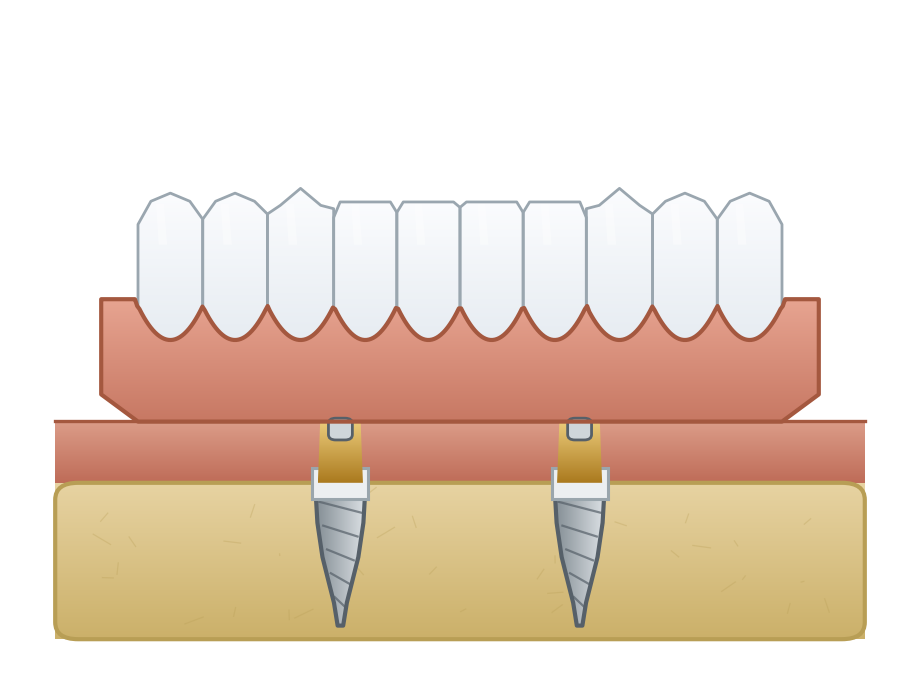 Illustration: Implant-retained denture (overdenture)