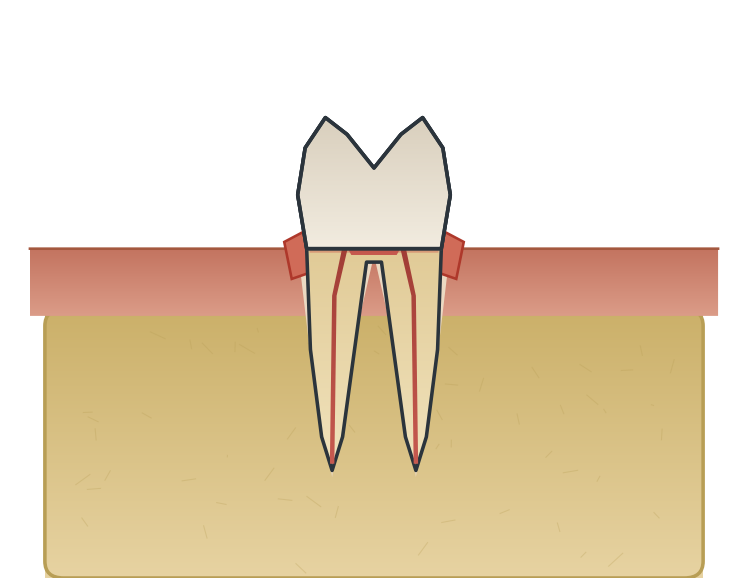 Illustration: Inflamed gum around a crown