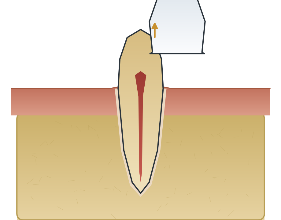 Illustration: Lost filling or crown