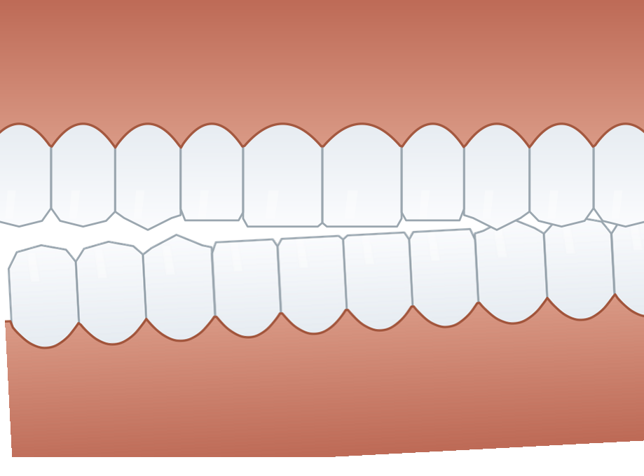 Illustration: Bite problems (malocclusion)