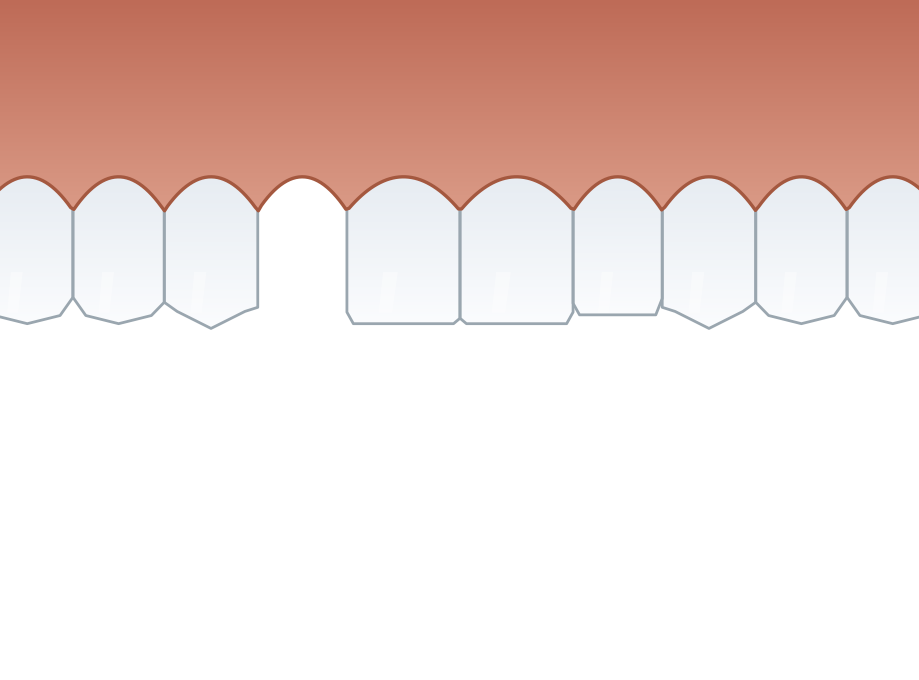 Illustration: Congenitally missing teeth