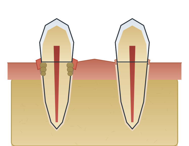 Illustration: Non-surgical periodontal therapy