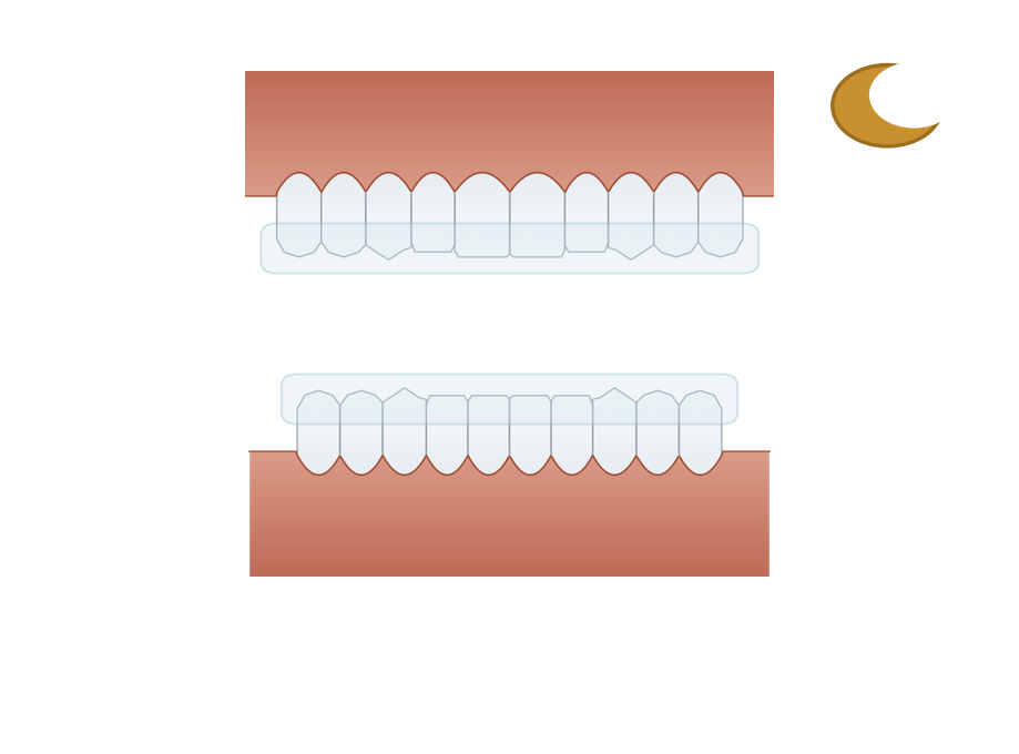 Illustration: Oral appliance therapy for sleep apnoea