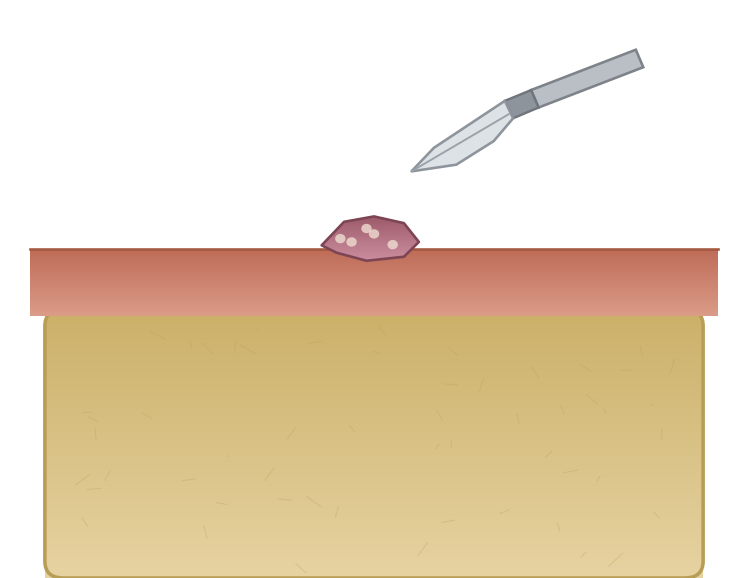 Illustration: Oral biopsy