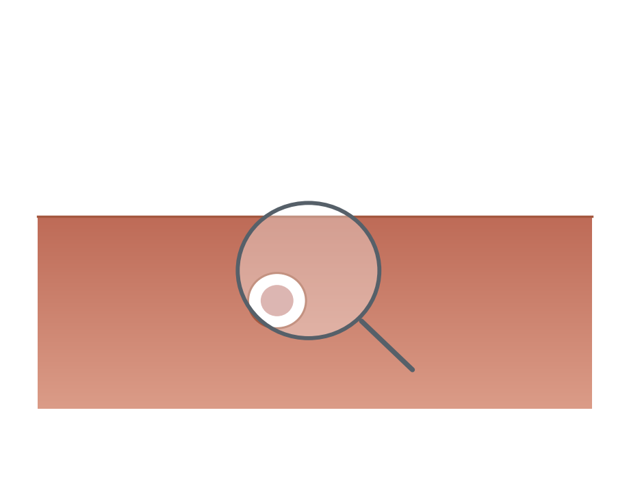Illustration: Oral cancer