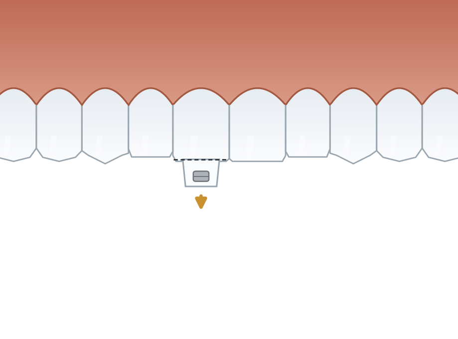 Illustration: Orthodontic extrusion