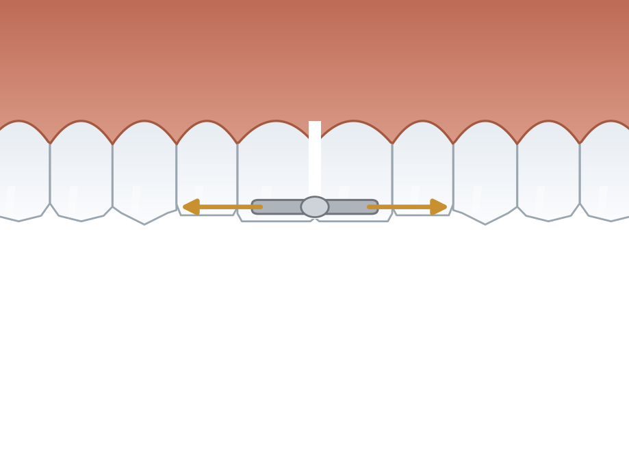 Illustration: Palatal expansion