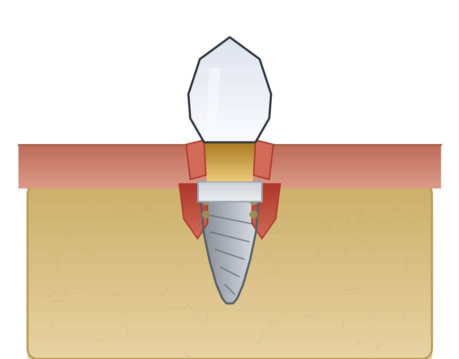 Illustration: Peri-implantitis