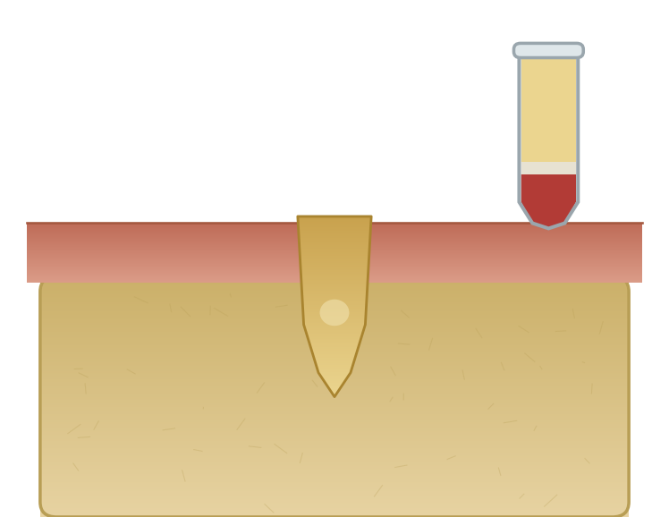 Illustration: Platelet-rich fibrin (PRF)