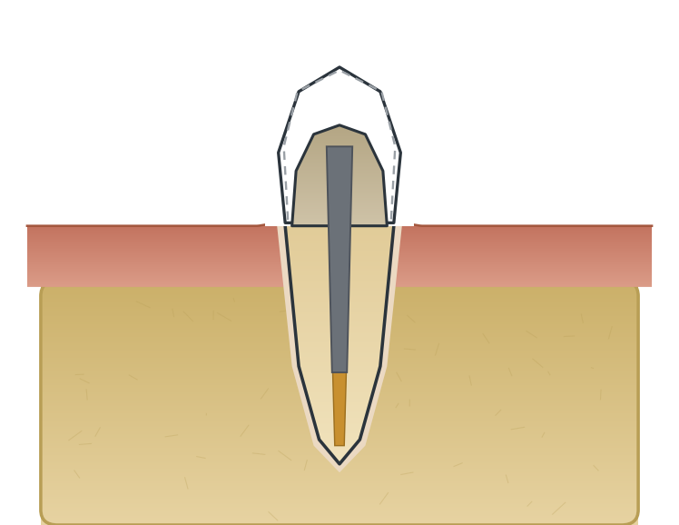 Illustration: Post & core / build-up
