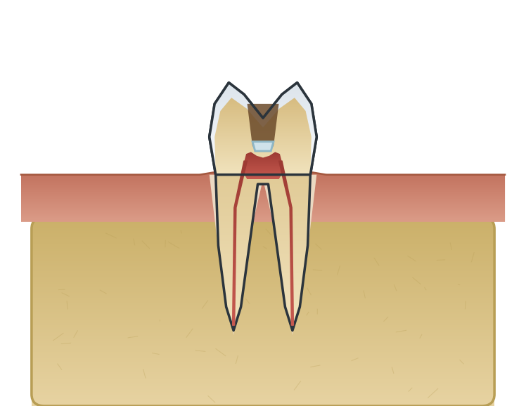 Illustration: Pulp capping