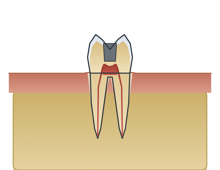 Illustration: Replacing silver (amalgam) fillings