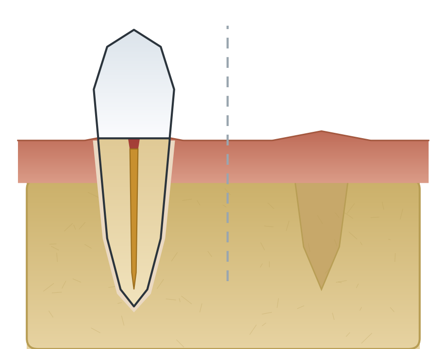 Illustration: Root canal or extraction?