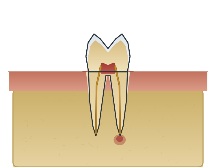 Illustration: Root canal retreatment