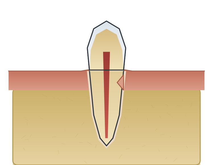 Illustration: Root resorption