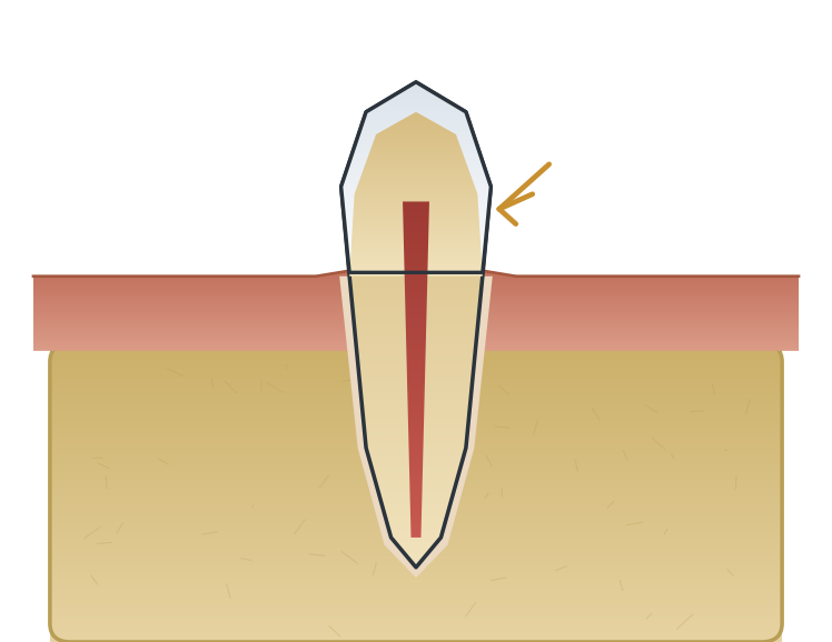 Illustration: Sensitive teeth