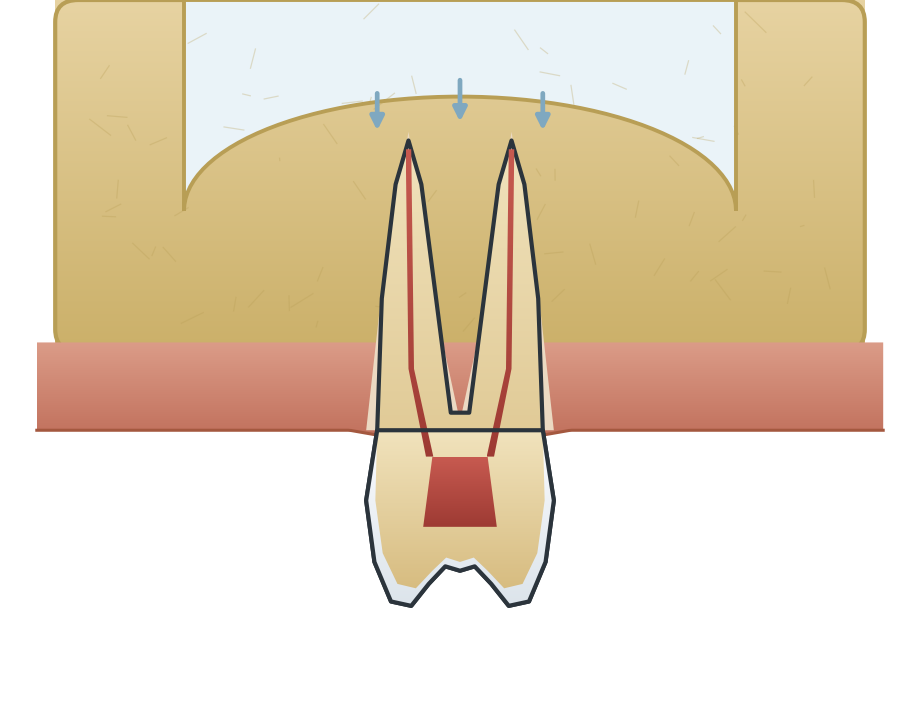 Illustration: Sinus pressure & tooth pain
