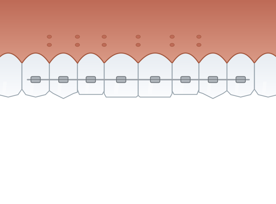 Illustration: Surgically-facilitated orthodontics