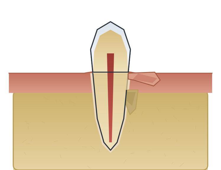 Illustration: Surgical periodontal therapy
