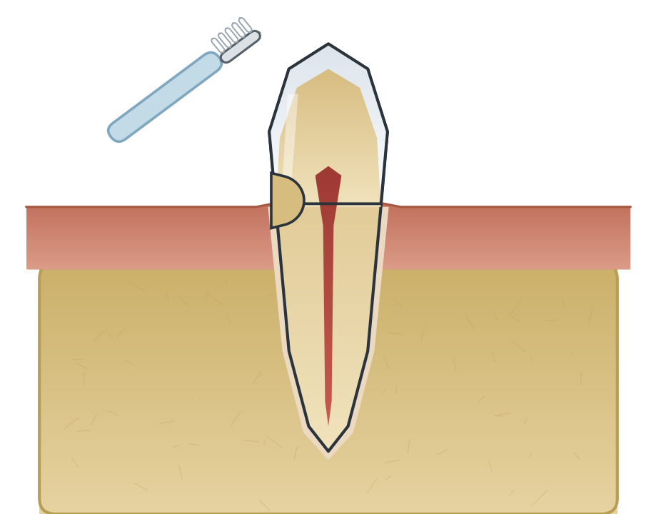 Illustration: Toothbrush abrasion