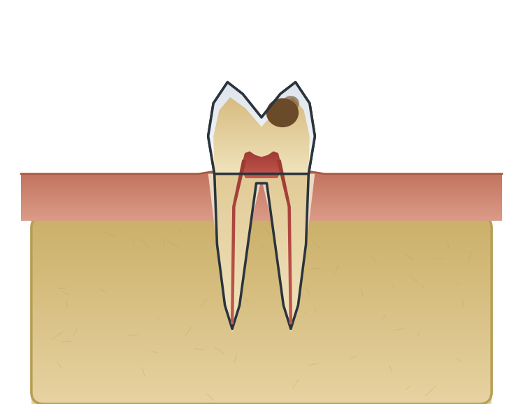 Illustration: Tooth decay
